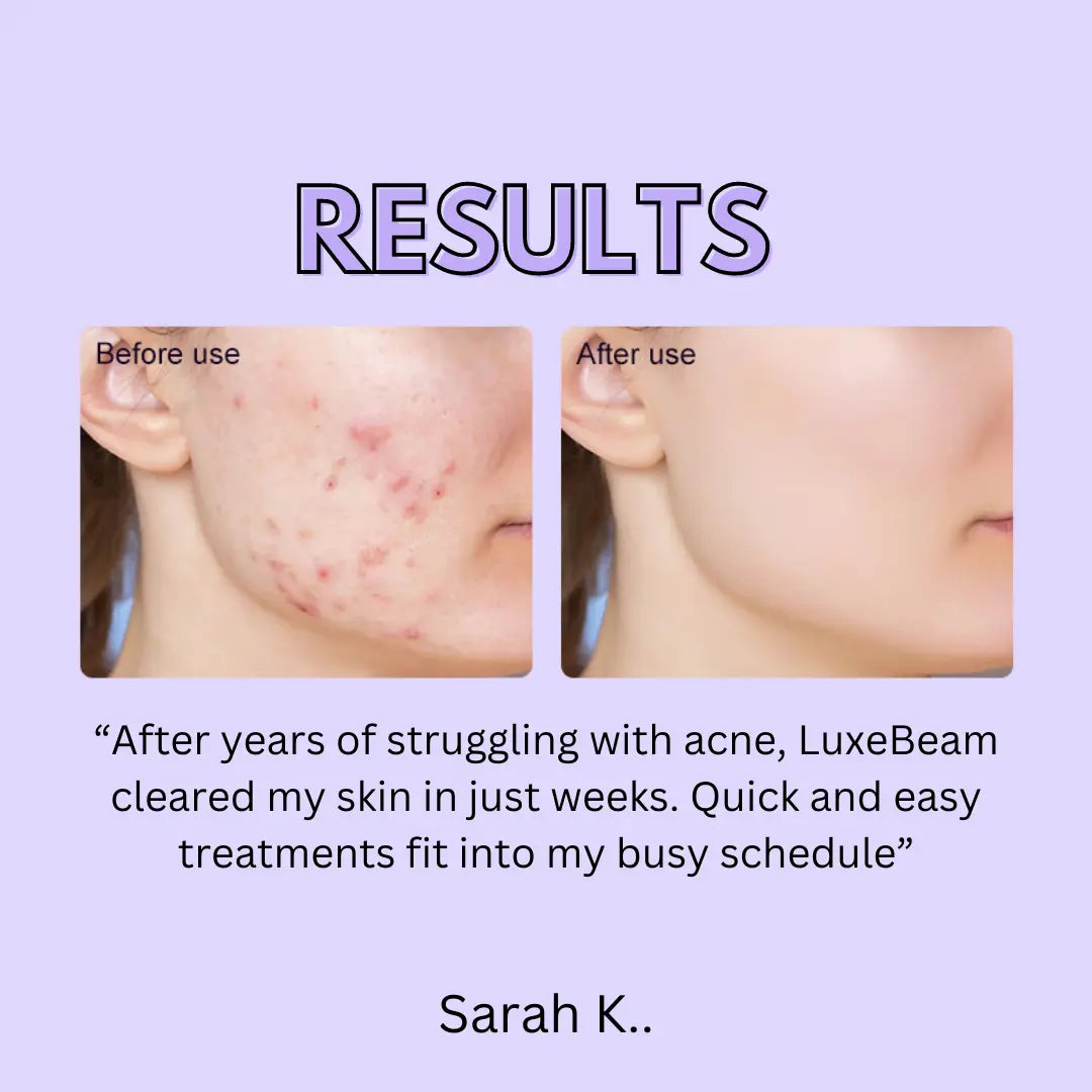 Dual Light Acne Therapy